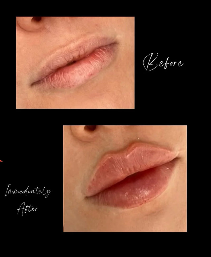 Cita de Botox con Adelfa