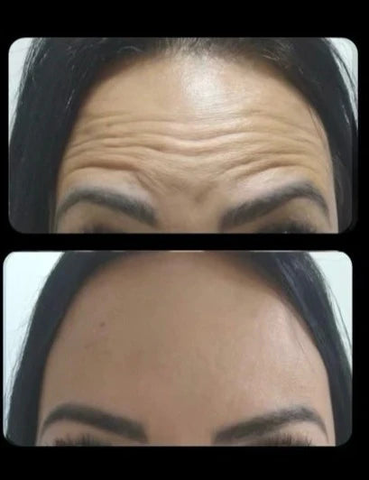 Cita de Botox con Adelfa